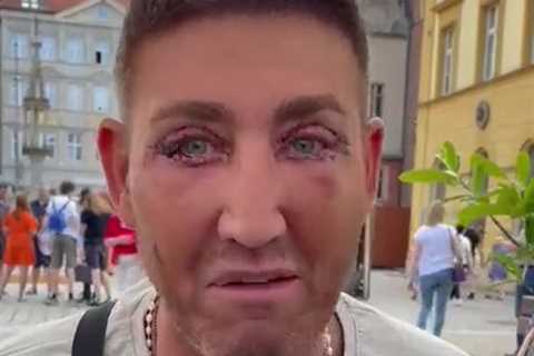 X Factor Star Christopher Maloney Reveals Bruised Eyes Following Eyelid Surgery in Poland