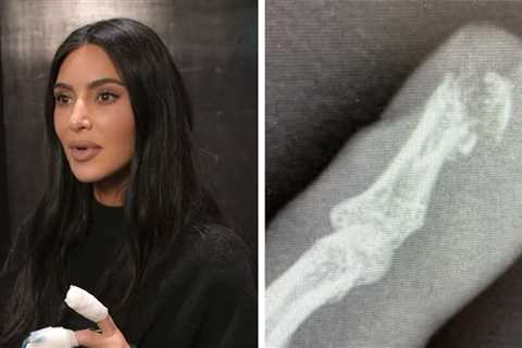 Kim Kardashian Shows Gory Injury, Fingertip Sliced Off, Bone Exposed