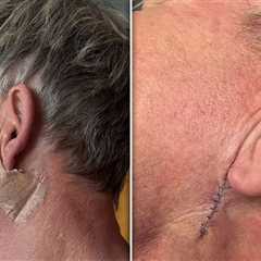 Gordon Ramsay Gets Treatment to Remove Skin Cancer, Shows Surgery Scar