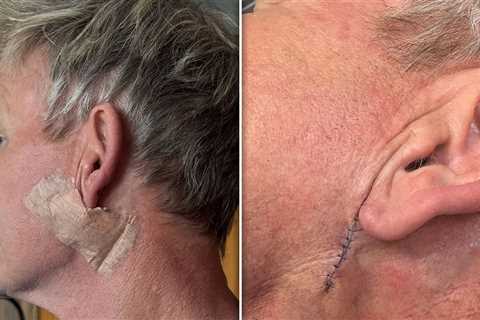 Gordon Ramsay Gets Treatment to Remove Skin Cancer, Shows Surgery Scar