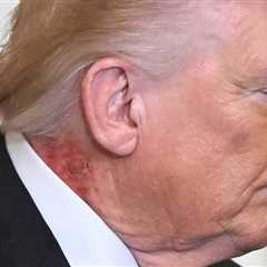 Nasty Rash Seen on President Trump's Neck at White House Press Conference