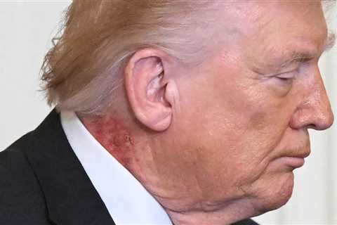 Nasty Rash Seen on President Trump's Neck at White House Press Conference